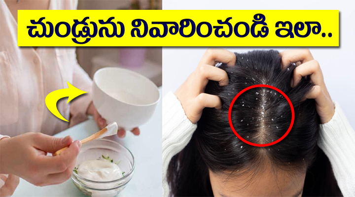 చలికాలంలో చుండ్రు సమస్యకు చెక్ పెట్టండిలా..!! 1 చలికాలంలో చుండ్రు సమస్యకు చెక్ పెట్టండిలా..!!