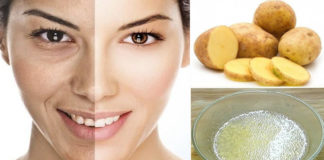 బంగాళదుంపతో పిగ్మెంటేషన్కు చెక్ !